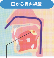 口から胃内視鏡