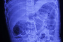 腹部レントゲン